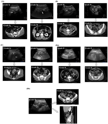 Figure 2. Comparison of findings by ultrasonography (US) with those by computed tomography (CT).(A) In more than 60% of cases, US Grades Ia were diagnosed as Grade Ia. The red arrow indicates the inflamed diverticulum. The arrow indicates the inflamed diverticulum. The arrowhead indicate the inflamed pericolic tissue. The letter “C” indicates colon.(B) In more than 90% of cases, US Grades Ib were diagnosed as Grade Ib. The arrow indicates the inflamed diverticulum. The arrowheads indicate the inflamed pericolic tissue. The letter “C” indicates colon.(C) In more than 25% of cases, US Grades Ic were diagnosed as Grade Ic. The arrow indicates the small abscess. The arrowhead indicates the inflamed diverticulum. The letter “C”indicates colon.Da,b) In more than 50% of cases, US Grades II were diagnosed as Grade II. The long arrow indicates a large abscess. The short arrow indicated free air. The arrowhead indicates air leakage. The letter “C” indicates colon.