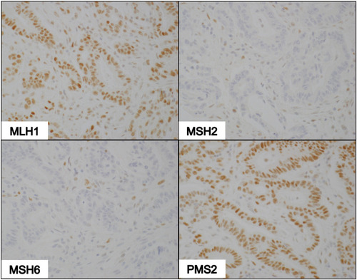 Figure 4 IHC of dMMR tumor deficient in MSH2 and MSH6. Photomicrographs show nuclear staining with MLH1 and PMS2 antibodies, and non-reactivity to MSH2 and MSH6 antibodies (100X magnification).