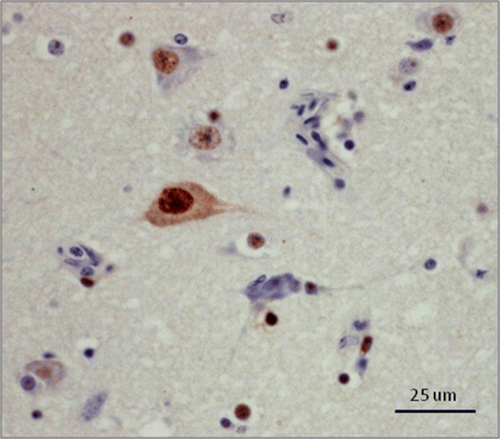 Figure 2.  (Colour online) Canada goose, cerebrum. Immunohistochemical staining for ABV antigen using rabbit polyclonal antiserum raised against ABV nucleocapsid protein. Note the intense intranuclear staining in neurons and glial cells, and the less frequent intracytoplasmic staining in neurons.