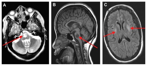 Figure 1 T1- and T2-weighted MRI data was acquired with the GE 1.5-Tesla magnetic resonance scanner (General Electric Healthcare Technologies, Waukesha, WI). A pontine lesion in axial (A) and sagittal (B) views, and lentiform hyperintensity in axial plane (C) are shown.