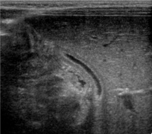 Figure 4 The gallbladder after 3 weeks of treatment – complete normalization of image.