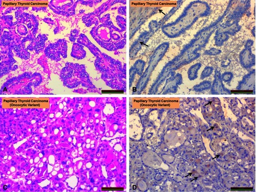 Figure 2 Comparison of irisin expression in papillary thyroid carcinoma and oncocytic papillary carcinoma. (A) Papillary thyroid carcinoma (H&E staining). (B) Papillary thyroid carcinoma (irisin staining). (C) Oncocytic papillary carcinoma (H&E staining). (D) Oncocytic papillary carcinoma (irisin staining). Arrows show irisin immunoreactivity (black arrows).Abbreviation: H&E, hematoxylin and eosin.