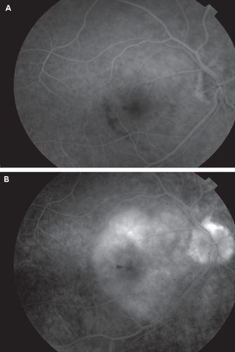 Figure 2 A: Fundus fluorescein angiogram demonstrating early hypofluorescence in the affected area. B: There was late staining with diffuse, non-progressive hyperfluorescence. There were no signs of a choroidal neovascular membrane.