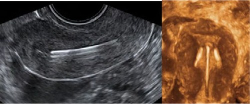 Figure 9 2-D/3-D ultrasonography: Position of the stem of the ParaGard intrauterine device (IUD), showing slight downward displacement (left). The arms of the IUD are unfolded and penetrate the muscular wall as the uterus is too small (right).