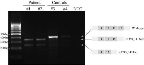 Figure 3. Agarose gel electrophoresis of PCR products. The wild-type transcript is only detected in the two control samples. Lower molecular weight products are detected in the patient’s sample. These bands correspond to a transcript with skipping of exon 11 (ca. 350 base pairs (bp) band) which results from the mutation c.1350-3C>G, and a transcript with skipping of exons 10 and 11 (ca. 245 bp band) that has also been observed at low levels in healthy subjects (Citation14). Indeed, this band is also visible in the control samples, although with less intensity than that observed in the patient. Please see supplementary Figure S1 for raw Sanger sequencing data. NTC: no template control.