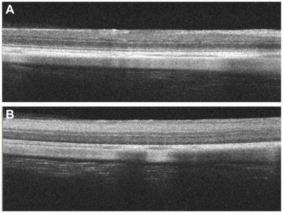 Figure 4 Optical coherence tomography images of the retina before (A) and after (B) euthanasia of 6-mm scan. Tomographic images of 6-mm-long show that neither the inner and outer segments nor the external limiting membrane are evident in a widespread area of rat retinas after euthanasia.