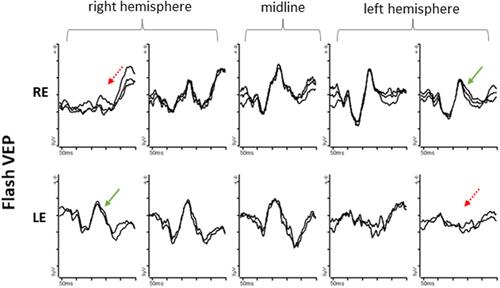 Figure 7 Flash VEPs from an 8-month-old patient with albinism using five occipital scalp electrodes; 2 electrodes over the right hemisphere; 2 electrodes over the left hemisphere; 1 electrode over the midline. Right eye (row 1) VEP responses are of higher amplitude from the left hemisphere compared with the right hemisphere. Left eye (row 2) VEP responses are of higher amplitude from the right hemisphere compared with the left hemisphere.