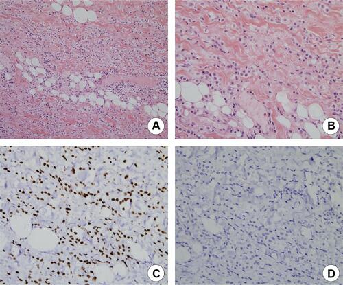 Figure 5 Histopathologic examination of right orbital biopsy specimen (case 2). (A) Section of biopsy specimen showing neoplastic cells. Increased pleomorphism. (H&E stain, ×20). (B) Increased nuclear size with increased nuclear/cytoplasmic ratio. Infiltration of normal muscle fibers and adipocytes by neoplastic cells (H&E stain, ×40). (C) Immunohistochemical staining of tumor cells, suggesting a metastatic adenocarcinoma from breast cancer (immunohistochemical staining positive for GATA3, ×200). (D) Immunohistochemical staining of tumor cells, suggesting a metastatic adenocarcinoma from breast cancer, lobular subtype (immunohistochemical staining negative for E-cadherin, ×200).