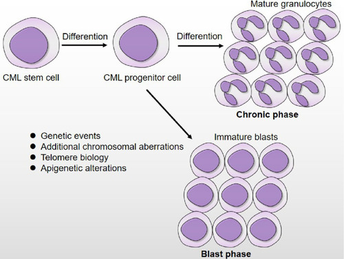 Figure 1 Disease progression of CML. During chronic phase, the CML stem/progenitor cells remain capable of differentiation and result in over production of mature granulocytes. In blast phase, differentiation of CML stem/progenitor has become arrested, leading to excessive accumulation of immature blasts that spill into the circulation. The biological mechanism that are responsible for CML blast transformation involves in genetic events, additional chromosomal aberrations, telomere biology and epigenetic alterations.