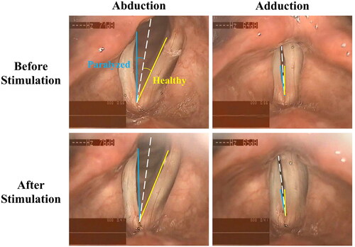 Figure 1. Typical laryngoscopic images before and after recurrent laryngeal nerve stimulation in a male patient. (A) and (B) show vocal fold abduction and adduction before the stimulation, while (C) and (D) show vocal fold abduction and adduction after the stimulation. In each panel, the white dashed line represents the glottal midline, while the yellow and blue solid lines illustrate the other side of glottal angles for the healthy and paralyzed vocal folds, respectively.