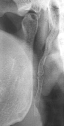 Figure 3 Type II – pseudoarticulated styloid process.