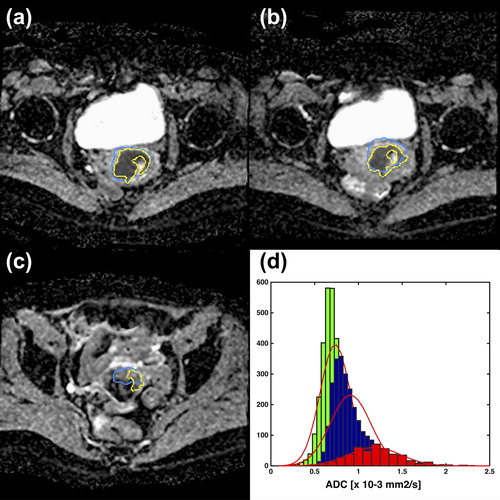 Figure 4. ADC images for one patient at the three different treatment time points: A: PRERT, B: WK2RT and C: PREBT. The yellow contour illustrates the segmented volume while the blue contour is the GTV as delineated on T2W images. In D the histogram of the ADC values for the three treatment time points is shown for PRERT (green), WK2RT (blue) and PREBT (red). The red contour shows the estimated Gaussian fit.