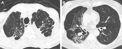 Figure 3 Axial CT images with a lung-window setting showing combined tubular and varicose bronchiectasis, emphysema and fibrosis in bilateral upper lobes (A), right middle lobe (B) and right lower lobe (B).Abbreviation: CT, computed tomography.