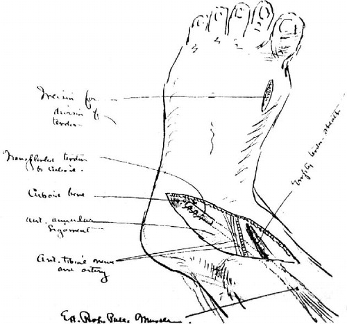 Figure 1. Part of Cushing's operative illustrations documenting the tendon transfer procedures. Case 1. The extensor proprius pollicis was released from its attachment through an incision on the dorsum of the foot, and sutured to the periosteum of the cuboid bone.
