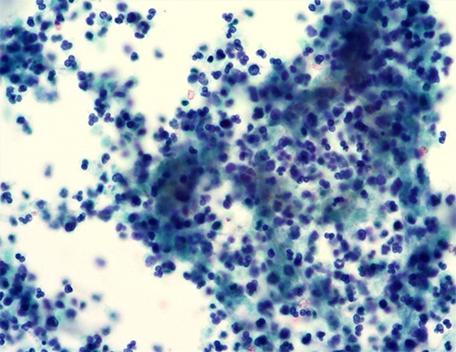 Figure 3 Histopathological photomicrograph: Papanicolaou stain, magnification ×200 showing numerous neutrophils with abundant background amorphous necrotic material, compatible with pus/abscess.