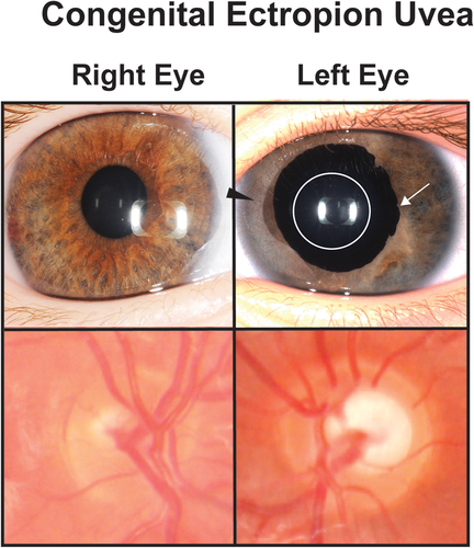 Figure 5. Congenital ectropion uvea (CEU). A patient with unilateral congenital ectropion uvea (left eye) shows the iris epithelium hypertrophy (white arrow) around the pupil (white circle). The iris also shows stromal atrophy (black arrowhead) compared to the unaffected right eye. The left optic nerve is also more cupped than the right eye demonstrating the effect of increased IOP.