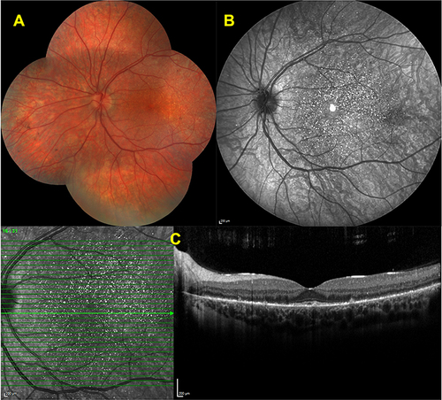 Figure 3 Features of early disease stage. Color fundus image of a left eye (A)showing scattered intraretinal crystals throughout the posterior pole. Infrared reflectance (IR-R) image (B) depicting the several bright reflective spots at posterior pole. Spectral domain-optical coherence tomography (SD-OCT) section (C) delineating the hyperreflective deposits at the retina pigment epithelium -Bruch’s membrane complex and ellipsoid zone (EZ) disruption in the left eye (C).