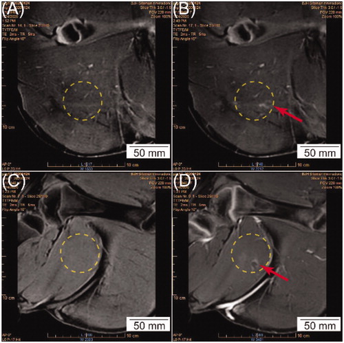 Figure 6. (A, C) A representative T1-weighted 3D high resolution isotropic volume excitation (THRIVE) MRI in the coronal view before HT. (B, D) Contrast-enhanced MRI in the coronal view in the same plane as (A, C) at the completion of HT, respectively. The yellow circle represents the cross-section of the beam path, and the red arrow shows hyper-intense regions detected in the cross-section of the beam path, indicating potential tissue damage.