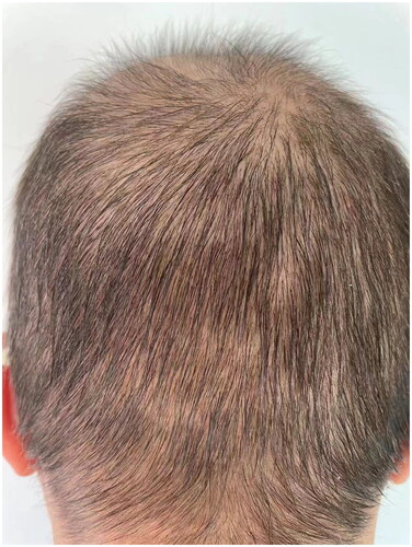 Figure 2. Hair regrowth on the occipital scalp after two-month abrocitinib treatment.