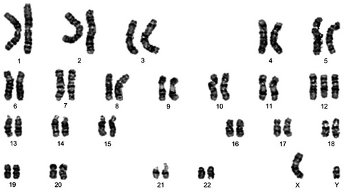 Figure 4 Trisomy 12 is the second most frequent karyotypic abnormality seen in CLL. Representative G-banded karyotype of a CLL with trisomy 12 as the sole karyotypic deviation. Karyotype: 47,XY,+12.