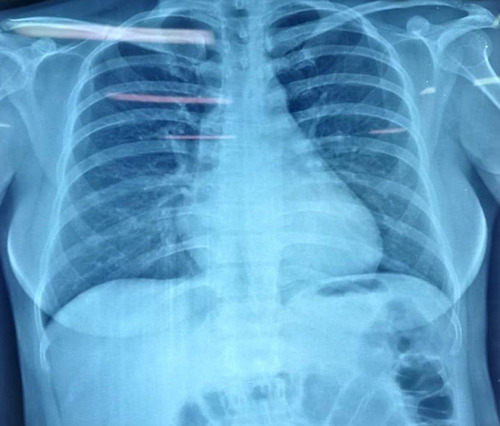 Figure 4 Admission chest radiograph, without any abnormality.