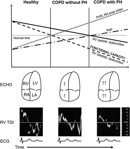 Figure 3. Schematic diagram demonstrating the hypothesized changes in the typical echocardiographic and hemodynamic parameters parallel with the course of the disease in patients with COPD.