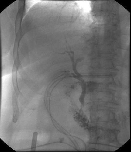Figure 4 Trans-Kehr cholangiography after the positioning of T-tube to protect biliary anastomotic suture.