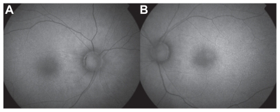 Figure 6 Fundus autofluorescence of right a) and left b) eyes 28 months postingestion demonstrating diffuse hyperfluorescence without evidence of RPE atrophic lesions OU.