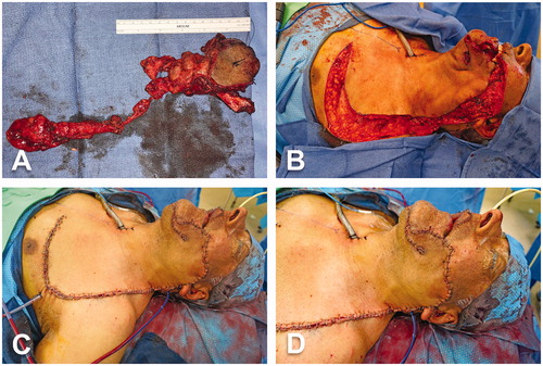 Figure 3. Intraoperative views (cont’d). (A) Surgical specimen including tumor and surrounding tissues, cheek skin, floor of mouth, segment of left mandible and lymphoareolar tissues of the left modified radical neck dissection. (B) Advancement and rotation of the cervicothoracic flap to cover the cheek defect. (C–D) Inset of the cervicothoracic flap.