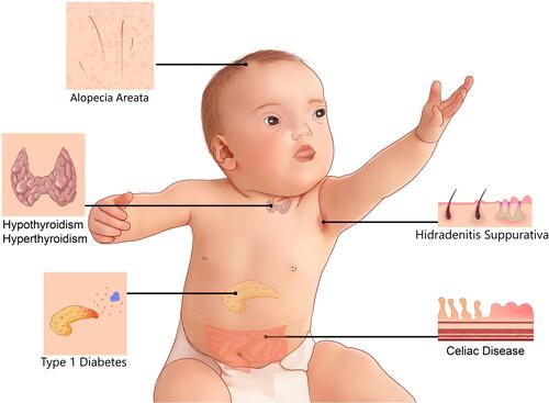 Figure 1 Common immune system-mediated disorders in DS.