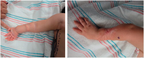 Figure 2. Preoperative photographs of the right forearm after scar release and two z-plasties with persistent severe contracture.