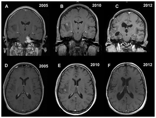 Figure 1 Contrast-enhanced coronal and axial T1-weighted magnetic resonance images showing the synchronous association of a left vestibular schwannoma and a right insular low grade glioma located in insular zone II–III according to the Berger–Sanai classification system (A and D). Five years later, magnetic resonance imaging documenting removal of vestibular schwannoma, as well as growth and possible high-grade transformation, because of the presence of focal areas of enhancement, of the right insular low-grade glioma (B and E). Postoperative final magnetic resonance imaging showing satisfactory removal of the insular oligodendroglioma (World Health Organization grade III), with only a small posteromedial residual tumor adjacent to the internal capsule, and stability of the left intrameatal vestibular schwannoma (C and F).