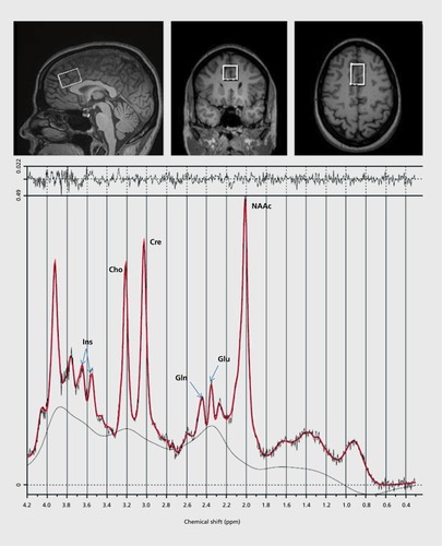 Figure 1. Single voxel location (2 x 2 x 3 cm) in the anterior dorsal cingulate cortex, shown in sagittal, coronal, and axial planes from MRI (top panel). A spectra, averaged from 196 acquisitions, collected from the above location at 3 Tesla, with a standard point resolved spectroscopic sequence (time to echo = 40 msec, time to repetition = 1500 msec), in about 5 mins. The fitted spectra (red line) has peak areas for glutamine (Gln), glutamate (Glu), N-acetyl-aspartate compounds (NAAc), total-creatine (Cre), myo-inositol (Ins) and choline (Cho) are labeled. Top irregular line represents the residual signal after fitting. Lower continuous line represents the baseline used for fitting with linear combination (LC) model (bottom panel).