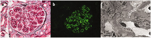 Figure 1. Light, immunofluorescence, and electron microscopy findings in a C3GN patient with monoclonal gammopathy (patient #15). (A) Light microscopy showed a membranoproliferative pattern of injury with a small fibrocellular crescent formation (Periodic acid-silver methenamine + Masson trichrome staining, ×400). (B) Immunofluorescence staining showed bright C3 in the mesangial and along segmental capillary walls (×400). (C) Electron microscopy showed electron-dense deposits in subendothelial, intramembranous and mesangial regions (×8000).