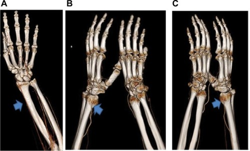 Figure 2 (A) The radial artery normally passes through the entire radial bone (arrow). (B) and (C) In the present patient, angiographic computed tomography revealed a variation of the radial artery where it was coursing above the styloid process as a superficial dorsal antebrachial artery (arrows).