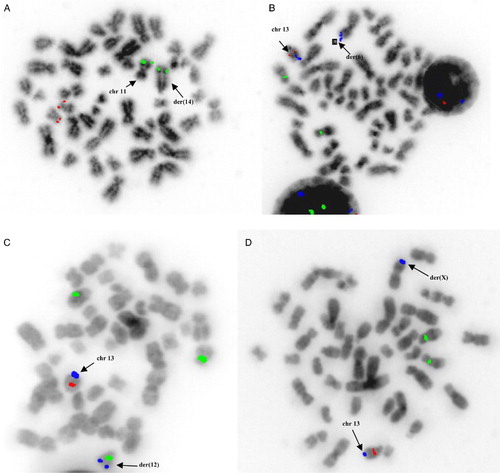Figure 1. Translocations undetectable by iFISH was observed in four patients by mFISH: (a) the chromosomal region 11q22.3 (ATM) (green signal) was translocated intact on 14q (red signal corresponds to 17p13.1/p53), (b) the chromosomal region 13q34.3 (blue signal) was found to be translocated intact on 6p (green signal corresponds to CEP12 and red to 13q14.3), (c) the chromosomal region 13q34.3 (blue signal) was found to be translocated intact on 12q (green signal corresponds to CEP12 and red to 13q14.3), and (d) the chromosomal region 13q34.3 (blue signal) was translocated intact on the short arm of chromosome X (green signal corresponds to CEP12 and red to 13q14.3).