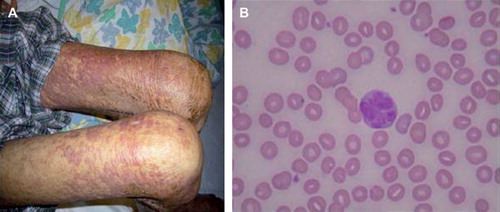 Figure 1A. Patient has skin involvement by the lymphoma. B. Flower cell (centre) in peripheral blood of the patient.