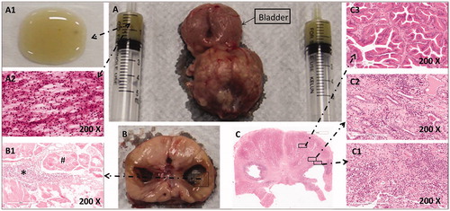 Figure 5. The pathological images of a beagle prostate were captured 1 month after TPLA (left 3w/600J, right 3w/1200J). (A) A prostate specimen with urinary bladder and fluid aspirated from the cavity of the ablated lesion. A1. The liquid appeared yellowish and sticky on the glass slide. (A2) The HE staining image of the liquid under high magnification (200 ×) showed unstructured necrotic debris and inflammatory cells. (B) A cross-sectional view of the prostate gland with an ablated lesion on each lobe. (B1) The HE staining image of the cavity wall showed necrotic tissues (#) and inflammatory cells (*) without a definite structure. (C) The HE staining image of a prostate section under low magnification (10 ×). C1. Inflammatory cells were seen on the wall of the cavity under high magnification (200 ×). C2. Inflammatory cells and normal prostate gland were seen in the MZ. C3. Normal prostate gland structures were seen in the NZ under high magnification (200 ×).