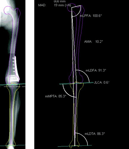 Figure 2. Digital analysis of leg geometry with the planning software. a) The contours of the femur, tibia and talus are drawn digitally. b) Measurement of the joint orientation angles, alignment and leg length by the software. [Color version available online]