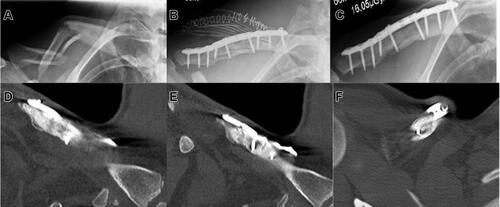 Figure 2 Displaced Allman type 1 fracture with free fragment; (A) preoperative axial radiograph; (B) postoperative axial radiograph after ORIF with a plate and screws and augmentation of both the bone defect and the plate with gentamicin-loaded bone graft substitute; (C) axial radiograph at 6 months showing bony consolidation; (D and E) coronal computed tomography (CT) scan at six months, various layers; and (F) transversal CT scan at 6 months confirming excellent bony consolidation.
