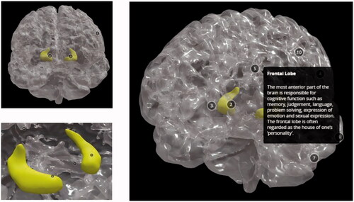 Figure 20. The finished 3D digital model: front view of the healthy brain (top left), view of the healthy hippocampus with camera view placed inside (bottom left), view of the entire 3D digital model with description of the frontal lobe (right).