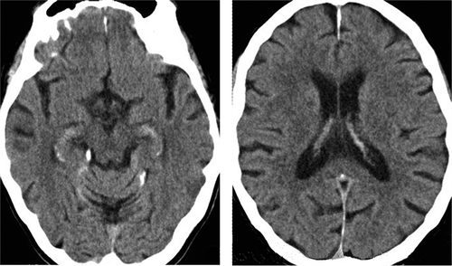 Figure 1. Computed tomography axial sections of the patient’s brain, at the level of the hippocampi (left panel) and inferior parietal lobes (right panel); the left hemisphere is shown on the right side of the image in both sections.