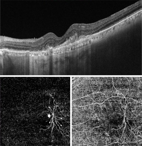 Figure 4 Upper, SS-OCT of the left eye of an 80-year-old male with AMD. Marked disorganization of the outer retina with marked thinning of the RPE and choriocapillaris and minimal intra-retinal fluid accumulation are shown. Lower, corresponding “en face” SS-OCTA image taken at the level of the outer retina (left) and the choriocapillaris (right) in a 6×6 mm field. The medusa head configuration composed of at least five large mature vessels (arrows) emanating from single main trunk (arrow head) is shown.