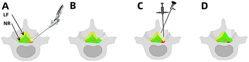 Figure 1 Illustrations of the pathologic features of LRS and decompression (Red: The disc material and posterior edge of the vertebral body; LF: The ligamentum flavum; NR: The nerve root). (A and B) Decompression of PTED. (C and D) Decompression of UBE.