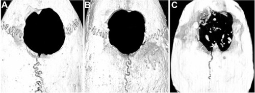 Figure 6 Micro-CT images of rat cranial bone after 8 weeks post-implantation. (A) Negative control; (B) Gelatin sponge loaded with PLGA@PEI; (C) Gelatin sponge loaded with PLGA@pBMP-2/PEI.Abbreviation: PLGA@PEI, poly(lactic-co-glycolic acid)@polyethlenimine; PLGA@ pBMP-2/PEI, poly(lactic-co-glycolic acid)@plasmid of bone morphogenetic protein 2/polyethlenimine; Micro-CT, micro-computed tomography.