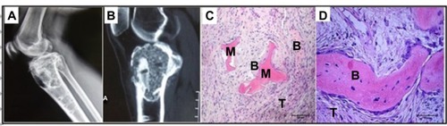 Figure 8 Images of the female patient that did not meet inclusion criteria due to recurring giant cell tumor.Notes: A woman, 46 years, suffered from giant cell tumor of the right proximal tibia and had shown recurrence after a follow-up of 2 years. She received treatment by tumor resection and single implantation of the porous composite. (A and B) show the X-ray image and magnetic resonance image of GCT recurrence; (C and D) show the histological images of GCT recurrence, (C) HE ×100, (D) HE ×200).Abbreviations: n-HA/PA66, nano-hydroxyapatite/polyamide 66; GCT, giant cell tumor; M, material; B, bone; T, tumor; HE, hematoxylin and eosin staining.
