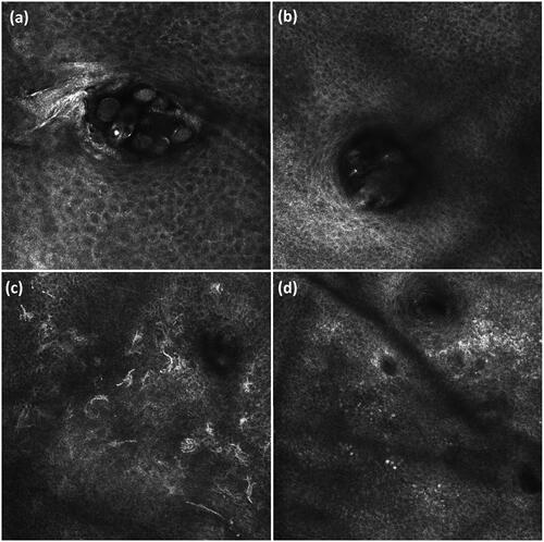 Figure 4. Confocal images of the cheek (0.5 × 0.5 mm2). (a) Follicle at the level of the stratum granulosum containing seven Demodex mites, clearly visible as bright, round contours. (b) Follicle at the level of the stratum granulosum with unclear content due to vague, white-roundish structures, included in mite category doubt. (c) Multiple bright, round to oval or fusiform cells with dendritic processes at the level of the dermo-epidermal junction, possibly melanocytes or Langerhans cells. (d) Multiple bright, round cells at the level of the dermo-epidermal junction, possibly inflammatory cells.