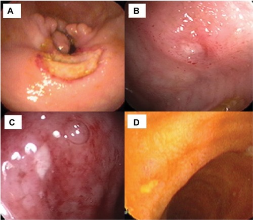 Figure 3 Endoscopic appearance of round ulcers of GI involvement of BS.