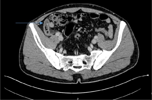 Figure 1 Dilated appendix, size 1.5 cm in maximal diameter (arrow).