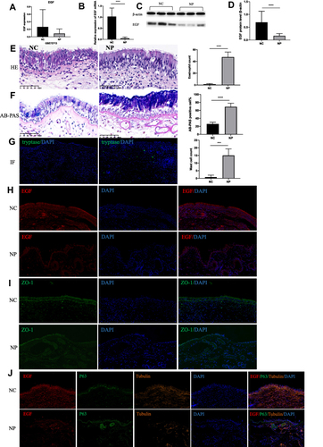 Figure 3 The expression level of EGF and the histologic appearance of nasal tissues. (A) The mRNA level of EGF were down-regulated in NP group in GSE72713. (B) The mRNA level of EGF were down-regulated in NP tissues of CRSwNP patients. (C) Western blot result of EGF in nasal tissues. (D) Densitometric analysis of EGF in nasal tissues. (E) Infiltration of eosinophils was examined using HE staining. (F) The hyperplasia of mucous cells was examined using AB-PAS staining. (G) Infiltration of mast cells was examined using immunofluorescence staining. (H) Immunofluorescence staining detect the expression of EGF in nasal tissues. (I) Immunofluorescence staining detect the expression of ZO-1 in nasal tissues. (J) Immunofluorescence staining localize the expression of EGF, P63, and Tubulin in nasal tissues. ****p < 0.0001, ***p < 0.001. (Original magnification, ×400).